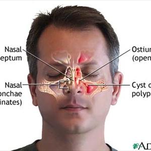 Medikament Gegen Akute Sinusitis 