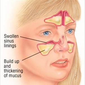 Sinusitis Medicinas 