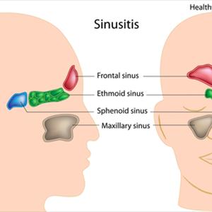 Sinus Histiocytosis - How To Achieve Sinusitis Relief Is Simple And Clear