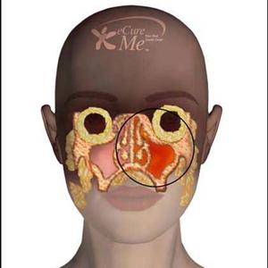 Sinusitis Common - Recurring Sinus Infection - An Explanation?