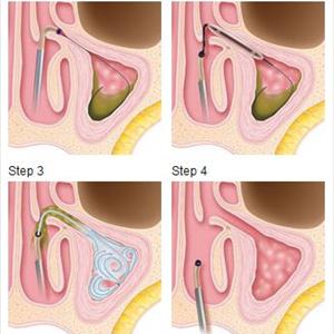  Sinusitis Among Children