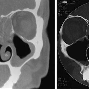 Paranasal Sinus Disease - What Medications Are Available For Treating Sinusitis?