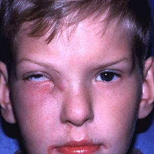 Sinus Infection Drain - Sinus Infection - Causes Of Sinus Infection