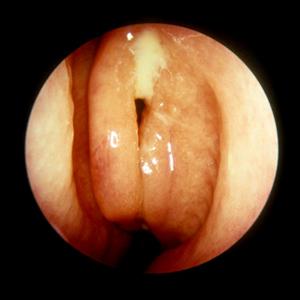 Of The Sphenoid Sinuses - Sinus Headache Relief In The Shape Of A Bed?