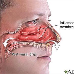 Sinusitis Ayurveda - How To Get Rid Of Sinus Pressure?