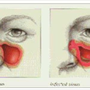 Of The Sphenoidal Sinus 
