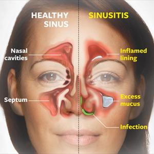  30% Of All People Suffer From Sinus Infections