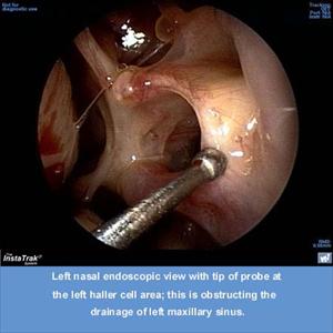 Sinus Congestion - Some Signs And Symptoms Of Sinus Infection