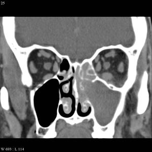 Functions Of Paranasal Sinuses - What Causes Sinus Infection?