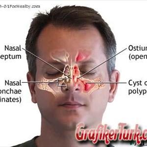 Untreated Sinusitis - Get Rid Of Sinusitis - Medical Treatment Or Natural Treatment - Which Way Is Right For You?
