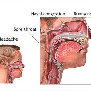  Treatment For Chronic Sinus Infection