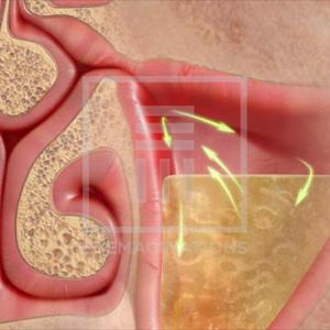 Sinusitis Ethmoid - Detecting Sinus Infection Symptoms Is Very Easy