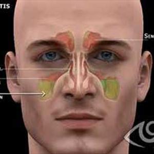 Cyst In Maxillary Sinus - Treating Sinus Disease