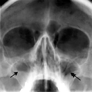  Dealing With Sinusitis