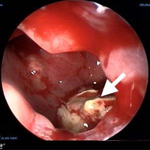 Sinusitis Antibiotics Treatment - Acute Sinusitis