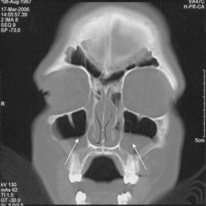 Sinusitis 2008 - When A Cold Is No Longer Just A Cold