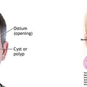 Chronic Sphenoid Sinusitis - Allergies Sinus Dizziness - How To Overcome Allergies, Sinus Dizziness