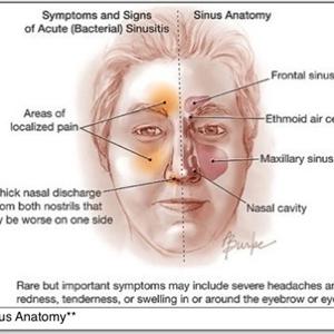 Nasal Sinus Surgery 