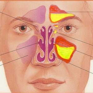 Sinus Tissue - Sinus Headache Symptoms That Warn Against Potential Problems