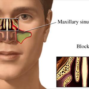 Facts About Sinusitis 