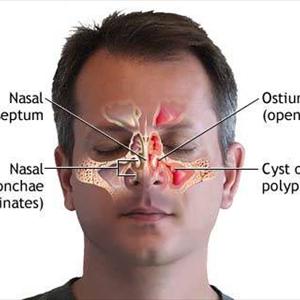 Clear Sinuses And - Complicated Sinusitis Information