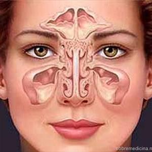 Sinusitis Herbal Medicine - Sinusitis And Bronchitis - Most Common Winter Diseases, Treatable With Homeopathy