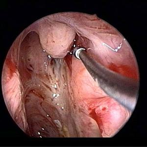  What Are The Sinusitis Symptoms?