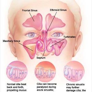Sinusitis Natural Relief - How To Get Rid Of Sinus Congestion?