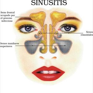 Sinus Doctor Joe Johnson - Maxillary Sinus Surgery