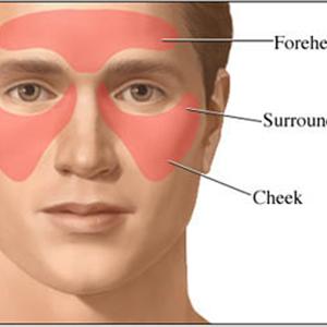 Sinusitis Causative Agent 