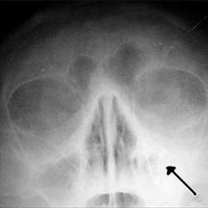 Maxillary Sinusitis Antibiotics 