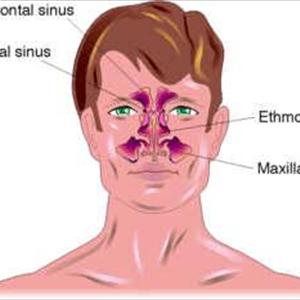 Blocked Sinuses Relief - Relieve Sinus Pressure - Yes You Can Stop The Torture!