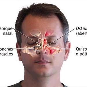 Causes Of Blocked Sinuses - How Can I Cure My Sinus?