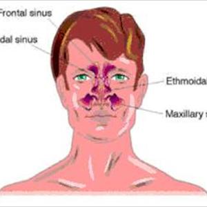 Sinusitis Herb - How Do I Get Rid Of Sinus Headache?