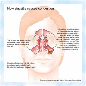 Sinusitis Patient Handout - At Last, A Sinusitis Cure Brings Suffering To An End