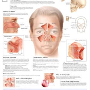 My Sinuses To Drain - Treating Rhinitis