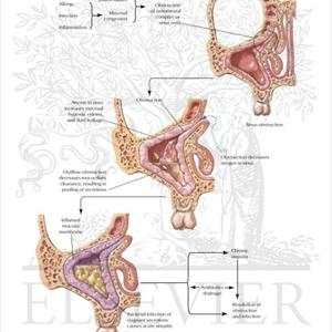 Of Sphenoid Sinus - How Do I Get Rid Of Acute Sinus Pain? - Say Goodbye To Acute Sinus Pain